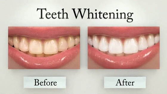 Does Teeth Whitening Work? | Klooster Family Dentistry