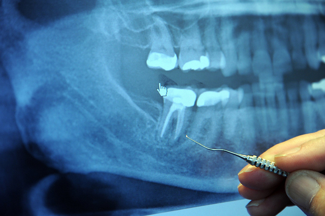 Root canals on X-ray